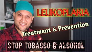 LeukoplakiaTreatment amp Prevention  मुंह में सफेद दाग के लक्षण कारण इलाज  Oral Hairy Leukoplakia [upl. by Ilellan976]