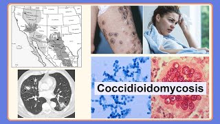 coccidioidomycosis [upl. by Treboh]