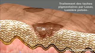 Traitement des tâches pigmentaires au laser  DR Barry [upl. by Kartis]