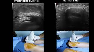 Ultrasound guided prepatellar bursitis injection Housemaids knee [upl. by Ermanno]