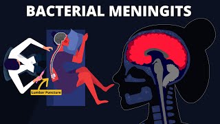 Bacterial Meningitis  Symptoms Diagnosis Treatments amp Pathology [upl. by Esikram]