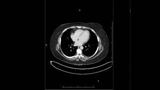 Peritoneum and Mesentery  Carsinomatosis  MRI Online [upl. by Tohcnarf]