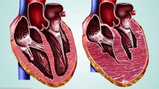 Miocardiopatia Hipertrófica [upl. by Ulberto31]