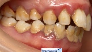 Treatment of Periodontal DiseaseBefore and After [upl. by Polky222]