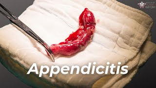 What should one avoid amp have post Appendix Surgery  Dr Viswanath S [upl. by Ailecara]