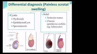 Testicular tumor —part 2 diagnosis amp management [upl. by Bock435]