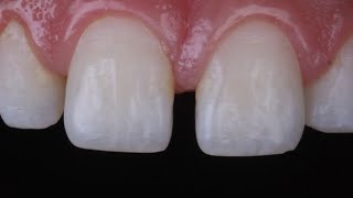 diastema closure with composite resin [upl. by Pierrette658]