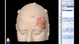 Removal of Brain Tumor Meningioma brain surgery [upl. by Merrielle]