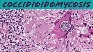 Coccidioidomycosis Coccidioides 5Minute Pathology Pearls [upl. by Erma156]