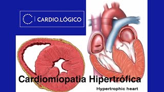 Cardiomiopatia Hipertrófica [upl. by Eastman567]