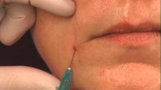 Instructions on Filling Nasolabial Folds With Dermal Fillers [upl. by Now919]