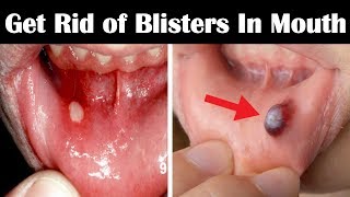 How to Get Rid of Blisters in Mouth Fast  Home Remedies for Blisters in Mouth and Tongue [upl. by Scot816]