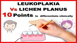 leukoplakia vs lichen planus  10 points to differentiate clinically [upl. by Novart]