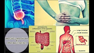 Appendix Pain  Location Symptoms Treatment Causes [upl. by Zelikow]