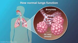 Understanding COPD [upl. by Revorg]