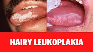 WHAT IS HAIRY LEUKOPLAKIA Oral Hairy Leukoplakia Symptoms Causes Diagnosis Treatment [upl. by Veleda788]