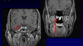 Imaging of the Nasopharynx [upl. by Harms]