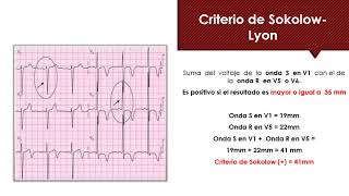 Hipertrofia Ventricular Izquierda Chile  Medicina Interna [upl. by Leahcimal]