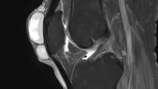 Prepatellar Bursitis [upl. by Thomasin]