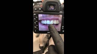 Correcting Crooked Teeth With Composite Bonding BeforeAfter [upl. by Teodora]