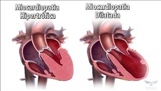 Miocardiopatia em 1 Minuto [upl. by Tobit244]