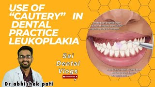 LEUKOPLAKIA  HOW TO TREAT [upl. by Eugenia]