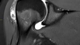 Bursitis of shoulder  First Look MRI [upl. by Nlycaj104]