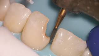 Teeth Bonding  Front tooth filling EXPLAINED [upl. by Elletnahc]