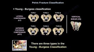 Pelvic Fractures  Everything You Need To Know  Dr Nabil Ebraheim [upl. by Dnomra657]