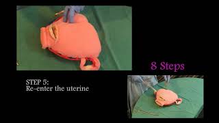 How to perform BLynch Suture [upl. by Heeley]