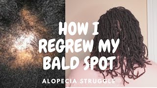 How I regrew my Bald Spot  Alopecia and locs 2023 [upl. by Catrina654]