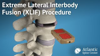 Extreme Lateral Interbody FusionXLIF Procedure [upl. by Enelehs]