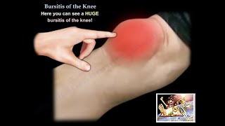 Knee Bursitis  Everything You Need To Know  Dr Nabil Ebraheim [upl. by Acimat]