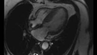 Cardiac MRI  Severe hypertrophic obstructive cardiomyopathy [upl. by Kenna]