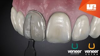 Uveneer® Procedure Animation  Direct Veneer Template System [upl. by Glenn903]