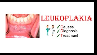 Leukoplakia  Causes Diagnosis amp Treatment [upl. by Annaer910]