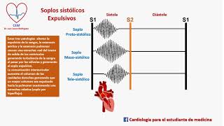 SOPLOS SISTOLICOS EXPULSIVOS [upl. by Nitreb]