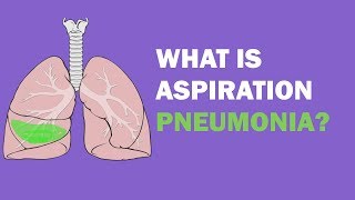 What is aspiration pneumonia [upl. by Garges416]