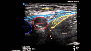 Ultrasound guided Femoral nerve block [upl. by Abbate203]