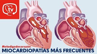 Tipos de miocardiopatías telodigodecorazón [upl. by Irab]