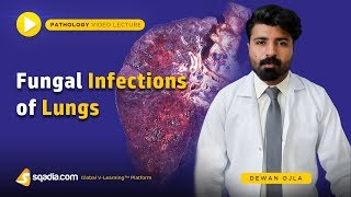 Fungal Infections of Lungs  Actinomycosis Histoplasmosis Coccidioidomycosis  Introduction [upl. by Trevah]