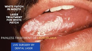 How to clear white patch in the mouth  LASER SURGERY FOR LEUKOPLAKIA LIVE SURGERY [upl. by Nwhas160]