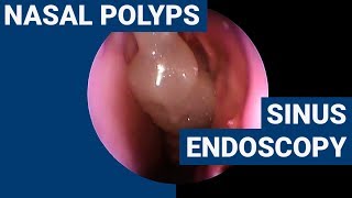 Nasal polyps  PHACON Sinus Patient Meyer [upl. by Ticknor243]