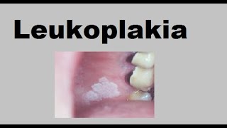 Leukoplakia [upl. by Modern]